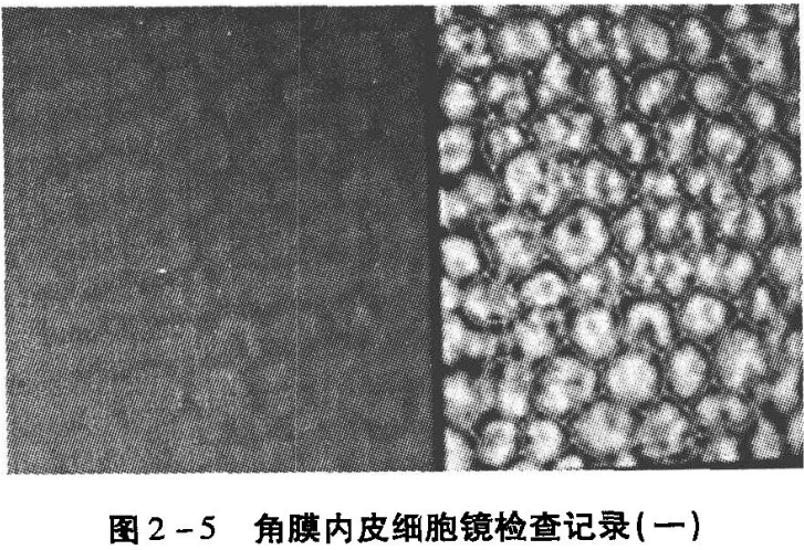 角膜内皮细胞读数的意义与应用