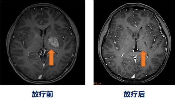 视网膜母细胞瘤，不治疗的后果与影响