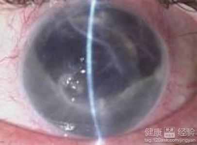 角膜内皮细胞少，探究其影响及应对之策
