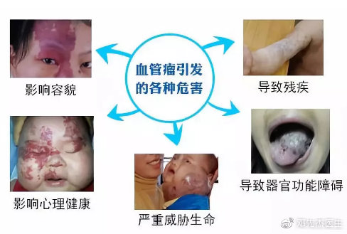 儿童血管瘤专家，守护生命之花的守护者