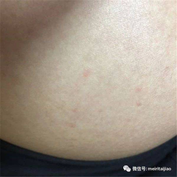 取卵腹水后身上很痒——一位女性的健康挑战与应对策略