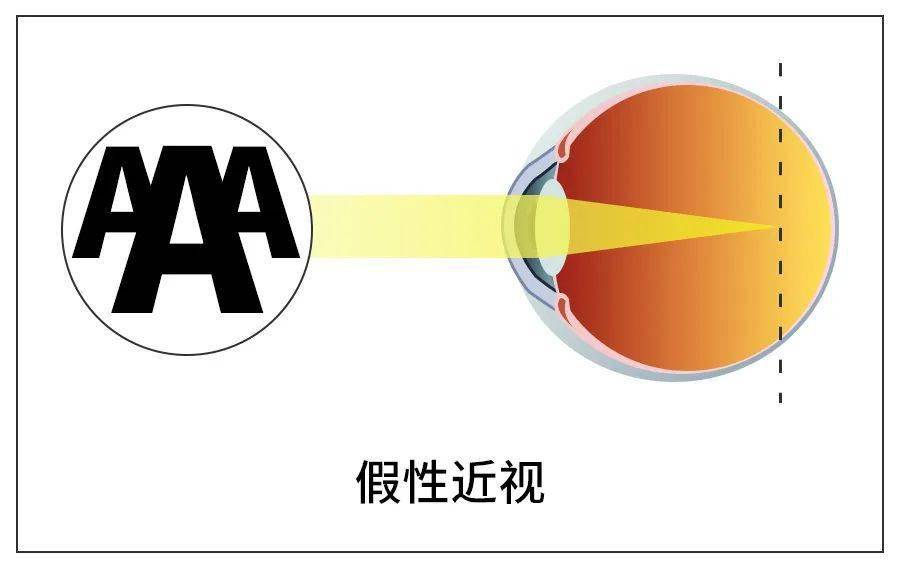 如何判定依视路镜片真假