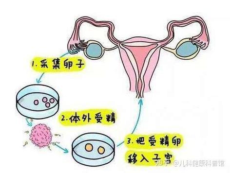 试管婴儿技术中的取卵数量，影响因素与应对策略
