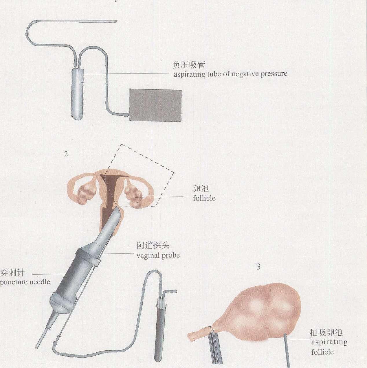 试管技术下的卵巢上举与取卵过程解析